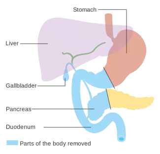 Diagram Showing The Parts Removed With A Whipples Operation CRUK 337Svg
